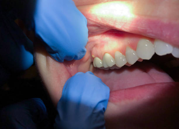 Best Emergency Dental Care for Broken or Chipped Teeth in Pryor Creek, OK