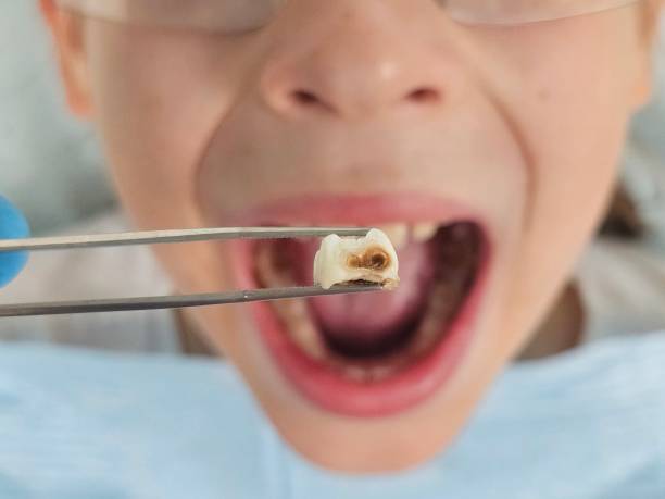 Best Emergency Wisdom Teeth Removal in Pryor Creek, OK